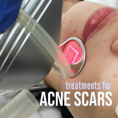 [:en]acnescars[:]