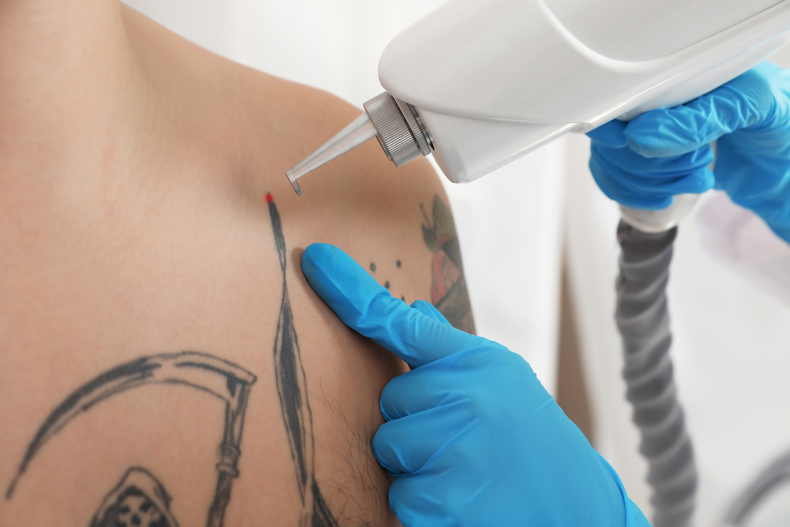 Laser Tattoo Removal – Healthsprings
