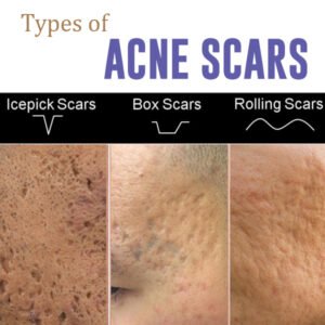 Types of Scars