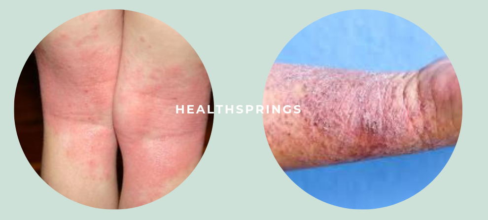 Guide to Eczema: Causes & Treatments - Healthsprings