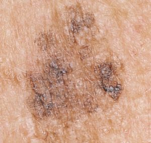 lasers to remove the pigmentation