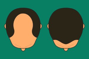 Hair loss