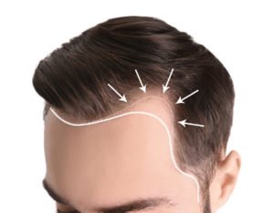 Laser Therapy For Hair Loss: The Benefits and Side Effects – Healthsprings