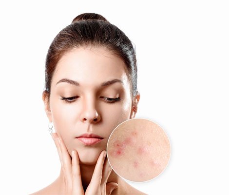 Acne Try These Effective Home Remedies