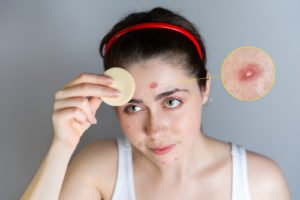 Home Remedies for Acne Treatment