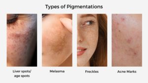 Is skin pigmentation bothering you