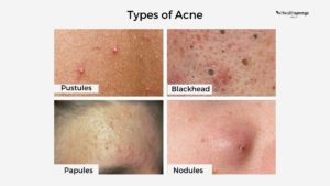 Types of Acne