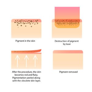 unwanted freckles and spots effectively