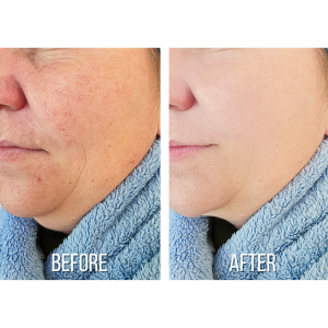 Treatment of rosacea usually