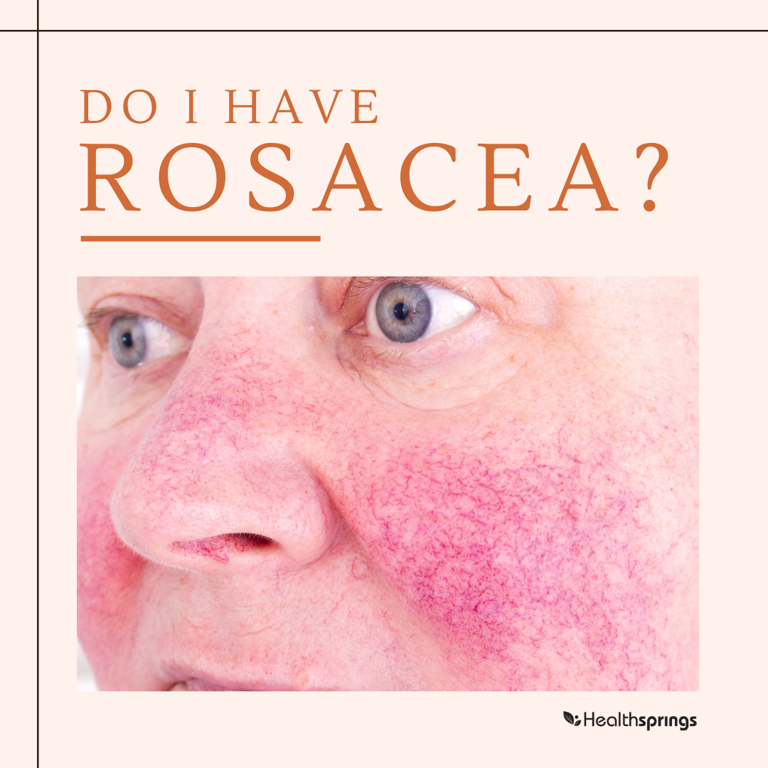[:en]rosacea blog post photo[:]