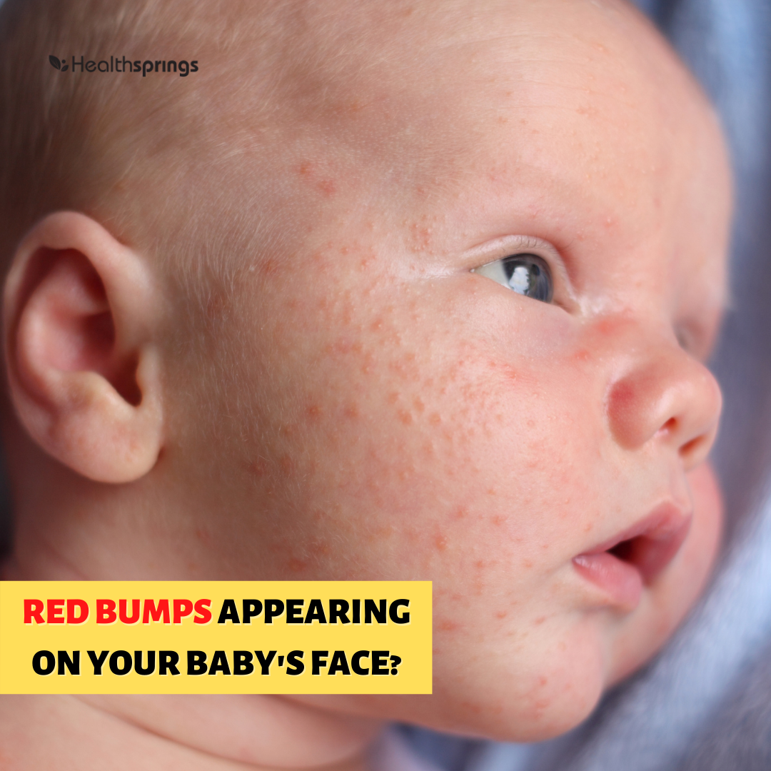 [:en]baby acne[:]