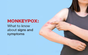 monkey pox tn