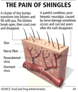 The pain of shingles - skin layer