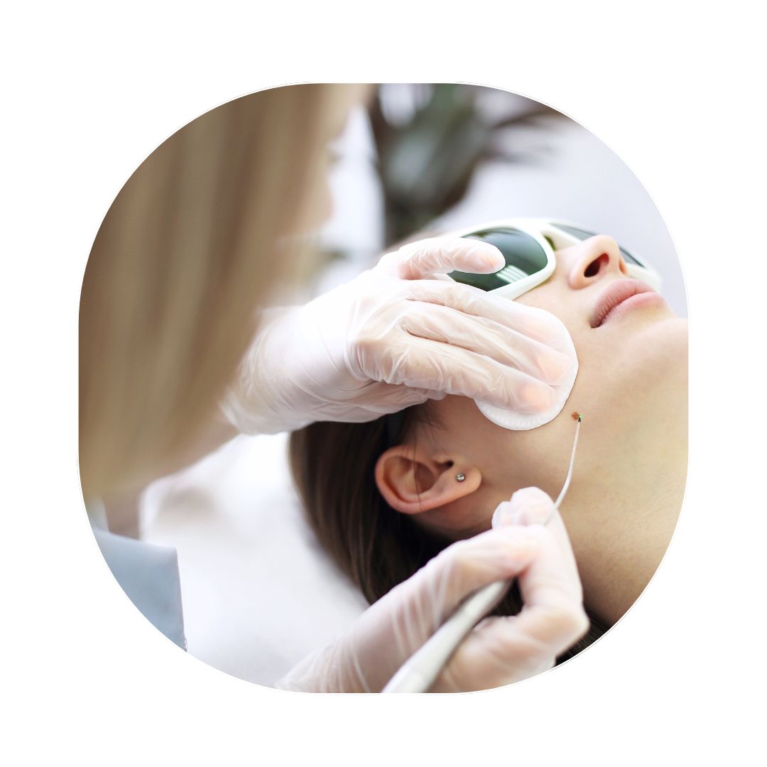 [:en]wart_mole-treatment-laser.jpg[:]