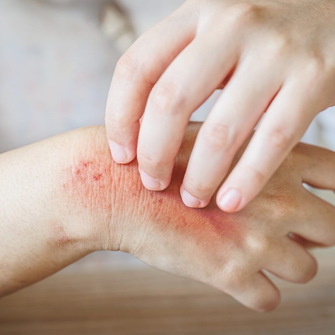 should you be worried about mpox? monkeypox skin rash